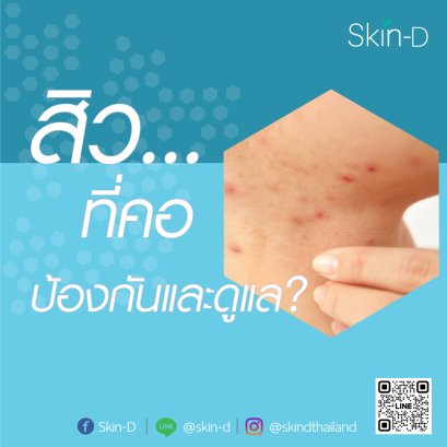 สิวที่คอ ปัญหากวนใจ... 9วิธีป้องกันและดูแลเมื่อเป็น