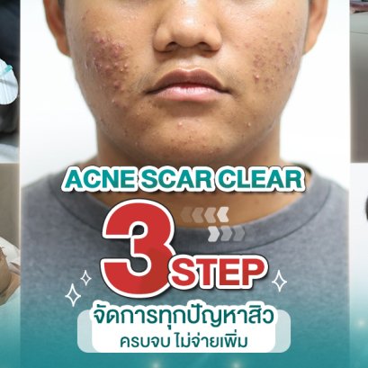 รีวิว รักษาสิวและรอยสิว ครบจบไม่ต้องจ่ายเพิ่ม ACNE SCAR CLEAR