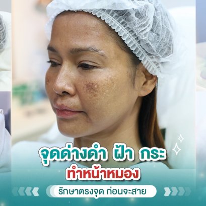 จุดด่างดำ ฝ้า กระ