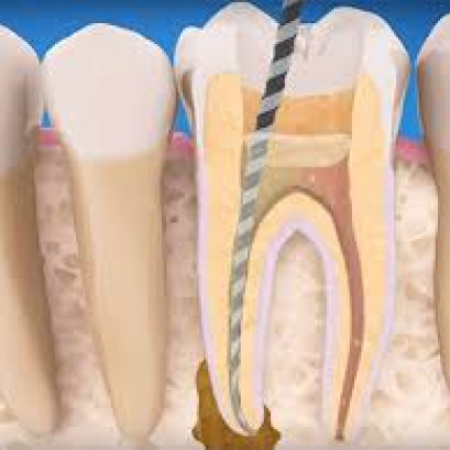 ทันตกรรมรักษารากฟัน