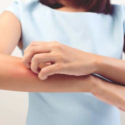 ผื่นในฤดูหนาว ปัญหาผิวหนัง ที่มาพร้อมกับความเย็น