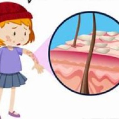 宝爸宝妈们，有话好好说 ---大声斥责孩子 可诱发儿童白癜风