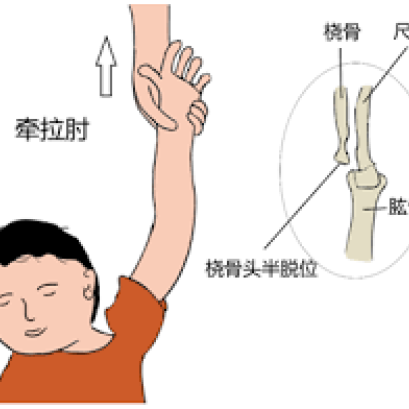 小孩子“胳膊脱臼”怎么办？