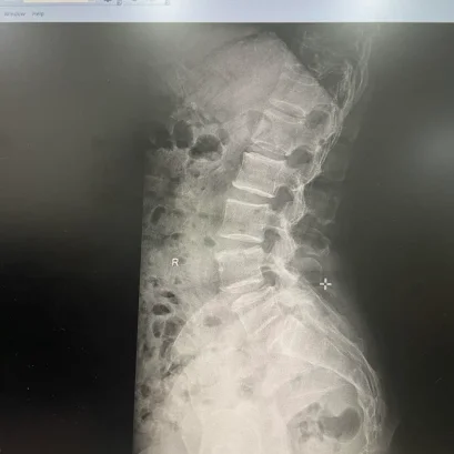 病例报告：慢性膝痛可能不仅仅是骨关节炎