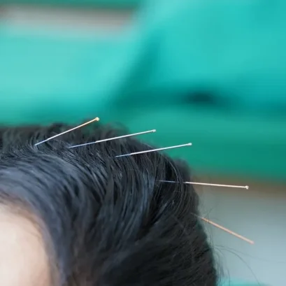 针灸联合导引治疗中风的原理 泰国华侨中医院脑病针灸康复门诊临床实践分享