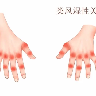 杨桂莲中医师解析： 关节疼痛是否等同于类风湿性关节炎？