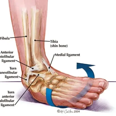 陈泰任中医师分享脚扭伤疼痛症状研究和治疗