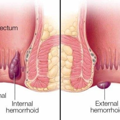 泰国华侨中医院黄紫薇中医师讲解有关痔疮的疑问，我们该如何保护？