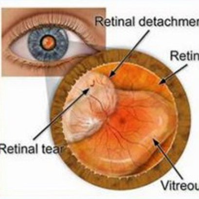 APCO - วุ้นตาเสื่อม ภัยสังคมก้มหน้า