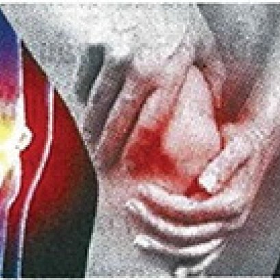 APCO - รักษาเข่าเสื่อมด้วยธรรมชาติ