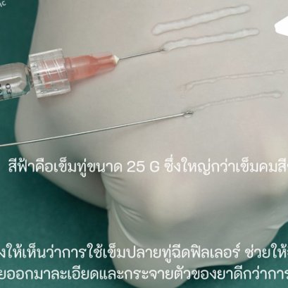 ฉีดฟิลเลอร์ปากกระจับที่ไหนดี ฉีดด้วยเทคนิคเข็มปลายทู่ ดีอย่างไร