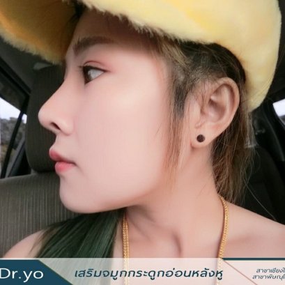 วิธีเตรียมตัวให้พร้อมทั้งก่อนและหลังการ เสริมจมูก เชียงใหม่