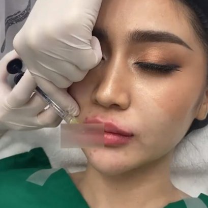 ฉีดฟิลเลอร์ปากกระจับที่ AIC CLINIC ประสบการณ์มากกว่า 10 ปี