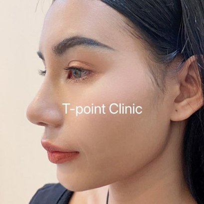 เหตุผลที่สาวๆภาคเหนือ ควรเลือกคลินิกทำจมูก เชียงใหม่