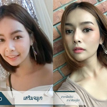 การศัลยกรรมจมูก อยากรู้ว่ามีกี่แบบ ต้องมาดูกัน