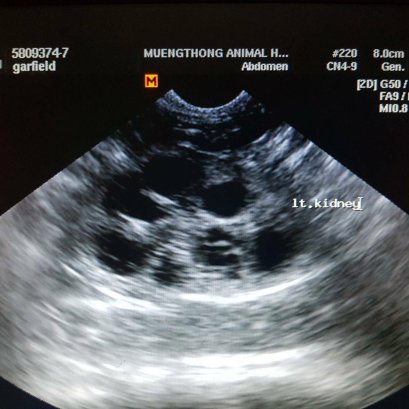 ถุงน้ำในไต!! เป็นได้ยังไงกันครับยังเด็กอยู่เลย?