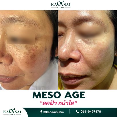 Meso age