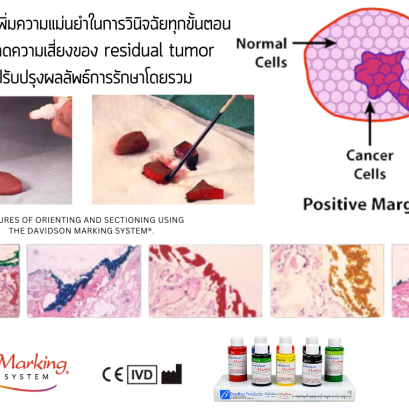 ค้นพบนวัตกรรมสีย้อมเนื้อเยื่อ- เพิ่มความแม่นยำในการวินิจฉัยมะเร็ง