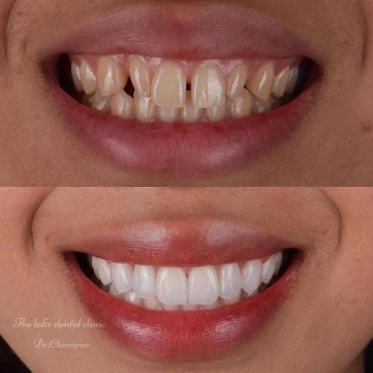 วีเนียร์ คือ อะไร? วีเนียร์เหมาะกับใคร ราคาเท่าไหร่