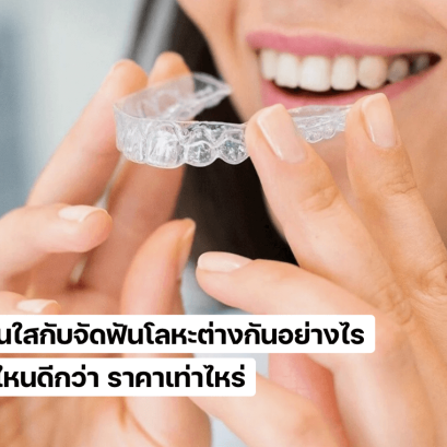 จัดฟันใสกับจัดฟันโลหะ แบบไหนดีกว่า ราคาเท่าไหร่