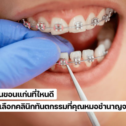 จัดฟันขอนแก่นที่ไหนดีที่คุณหมอชำนาญจริง