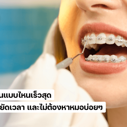 จัดฟันแบบไหนเร็วสุด และไม่ต้องหาหมอบ่อยๆ