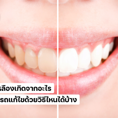 ฟันเหลือเกิดจากอะไร วิธีแก้ไขฟันเหลือ