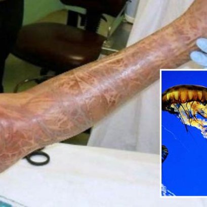 ระวัง พิษร้ายจากสัตว์ทะเล