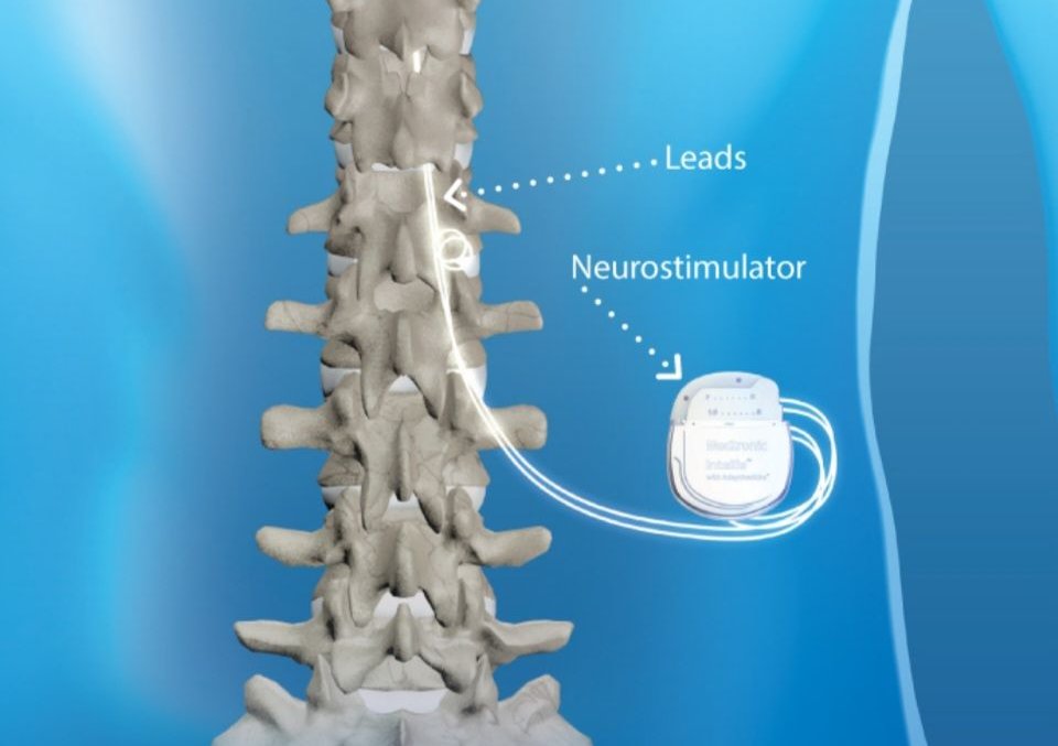 spinal cord stimulator เครื่องกระตุ้นไฟฟ้าไขสันหลัง spinal cord stimulator เครื่องกระตุ้นไฟฟ้าไขสันหลัง
