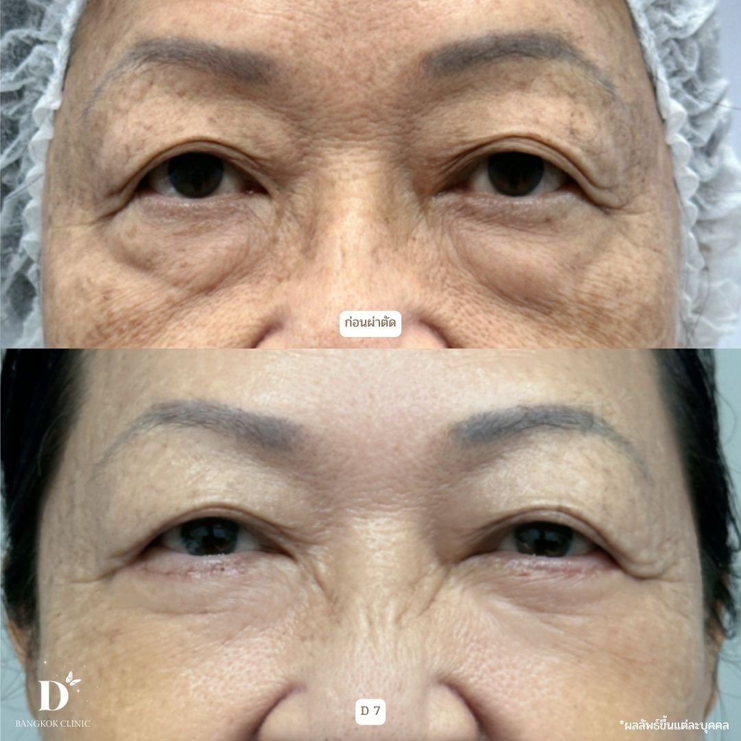 Trancutaneous lower blepharoplasty (external incision)