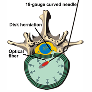 Percutaneous Laser Disc Decompression Pldd