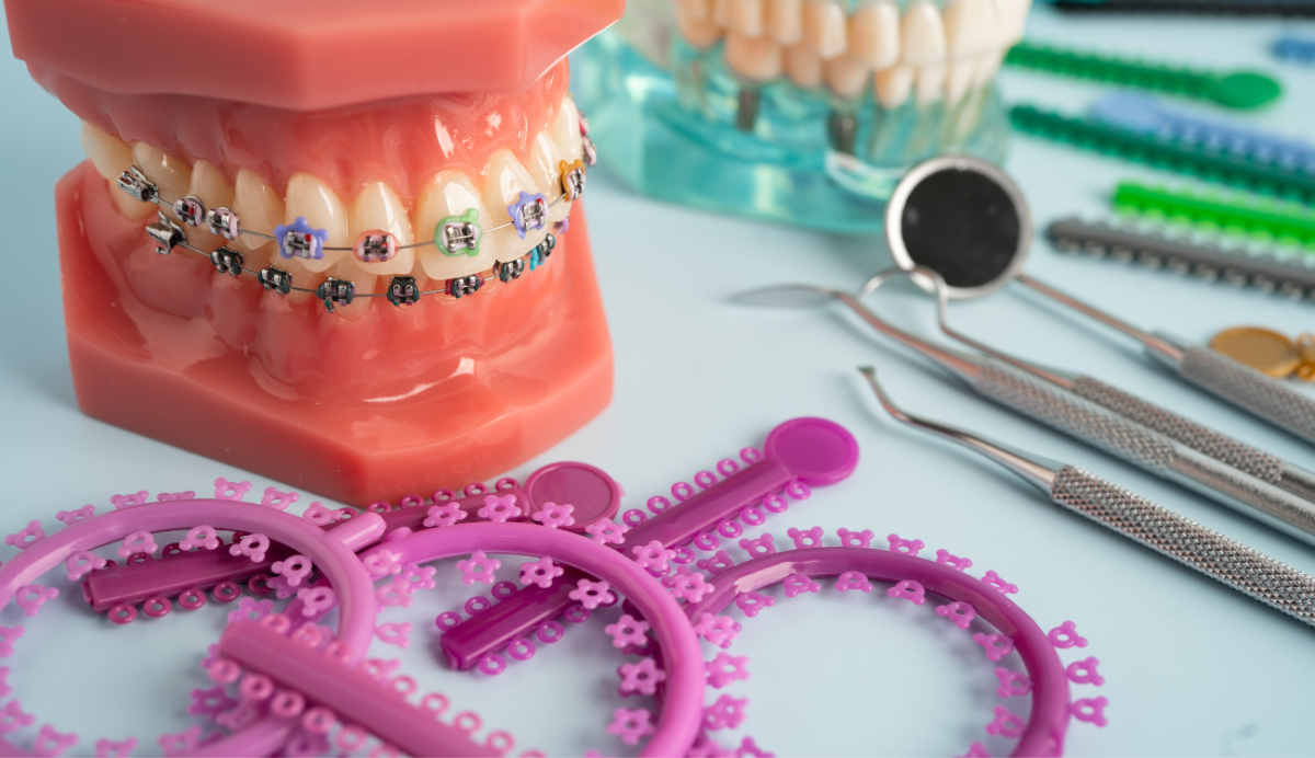 Power Chains for Braces: How Many Types Are There and Why They Matter