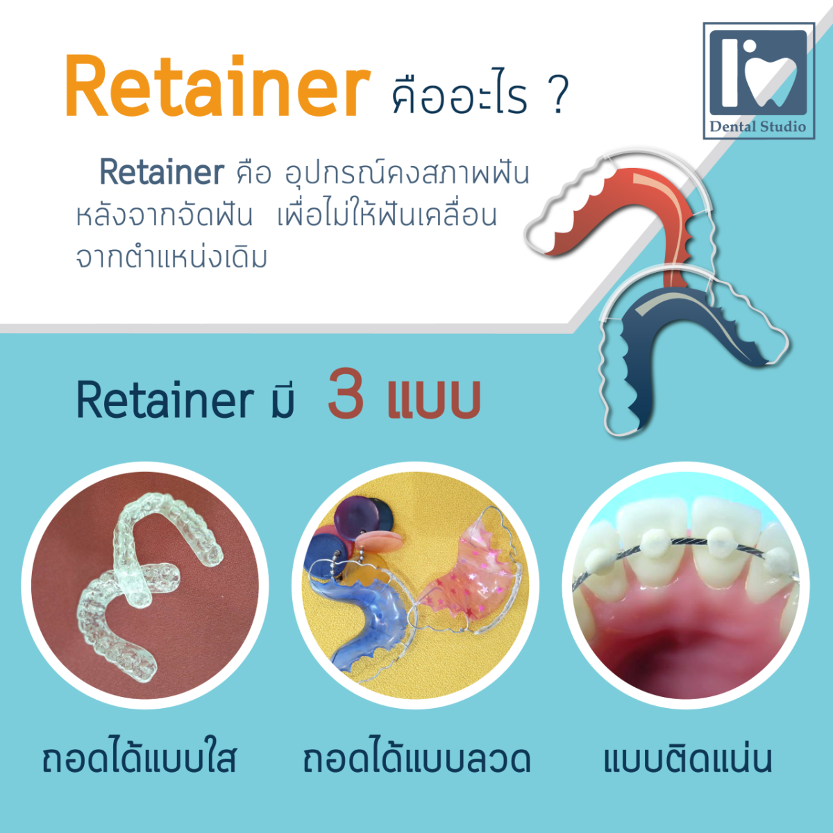 รู้ไหมรีเทนเนอร์ใส และ รีเทนเนอร์ลวด (Retainer) มีหลายแบบนะ