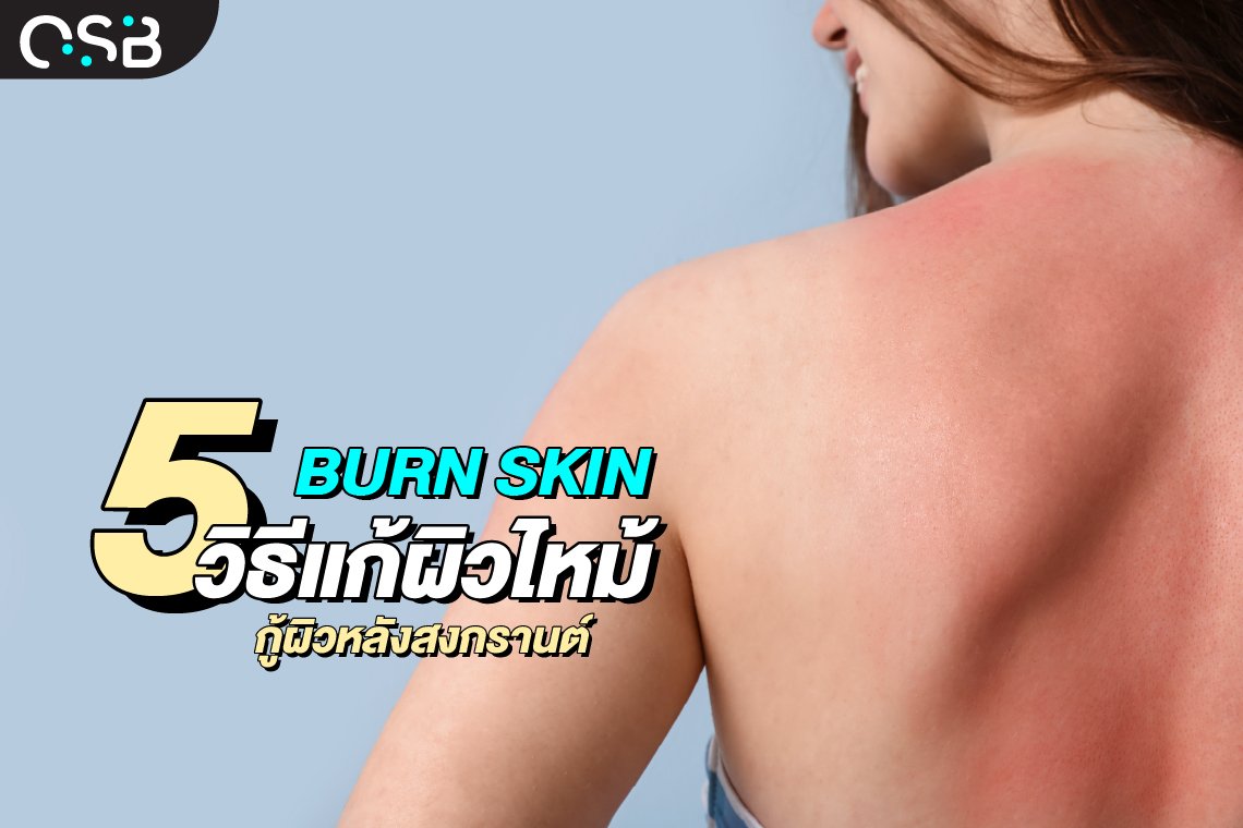 5วิธีแก้ผิวไหม้ กู้ผิวหลังสงกรานต์ (Burn skin)