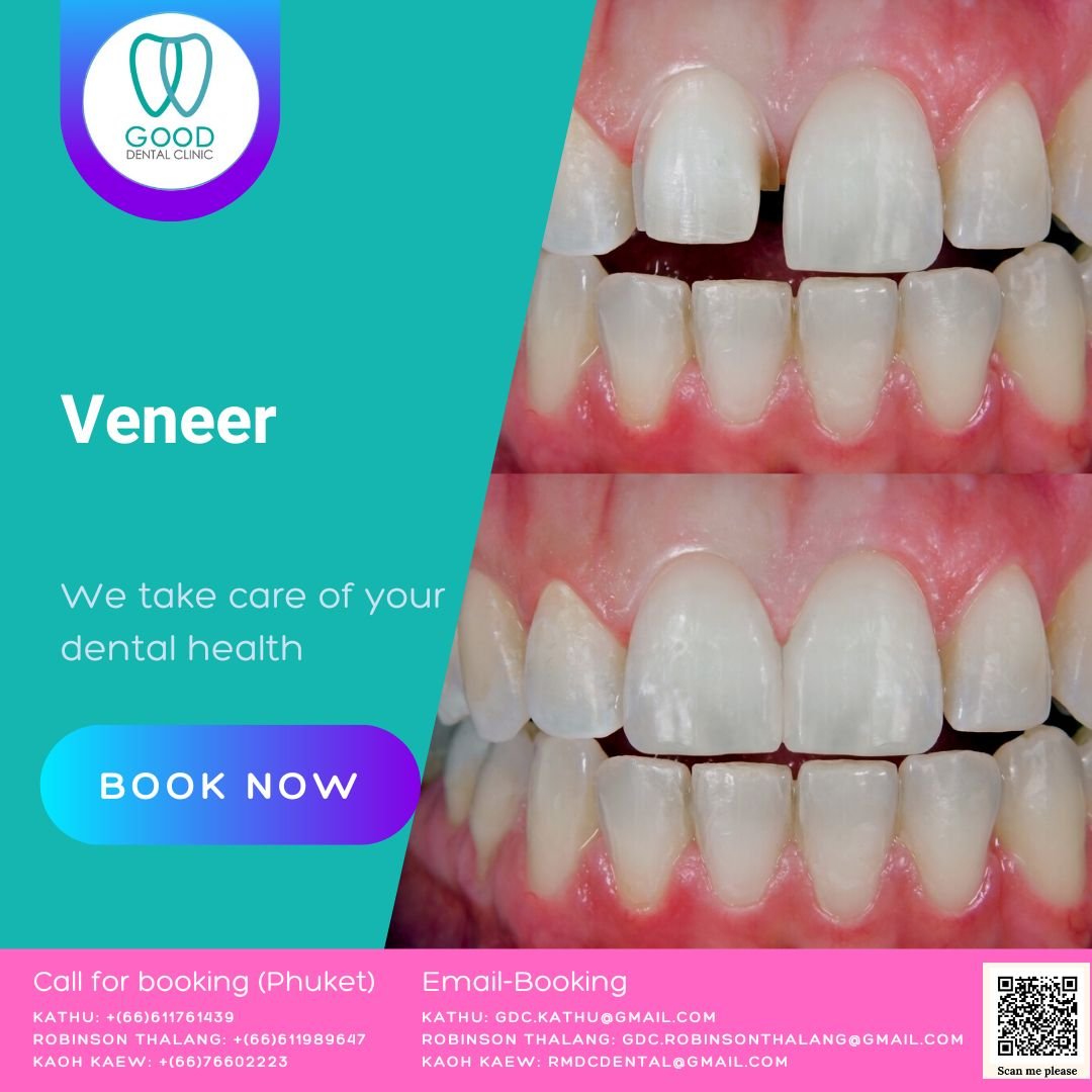 Dental Veneer