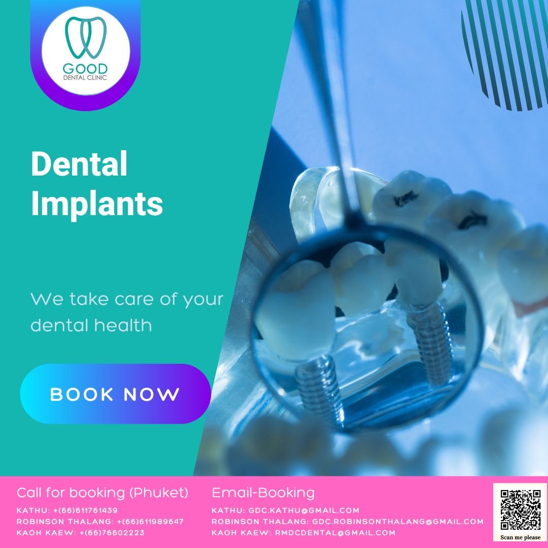 Dental Implants