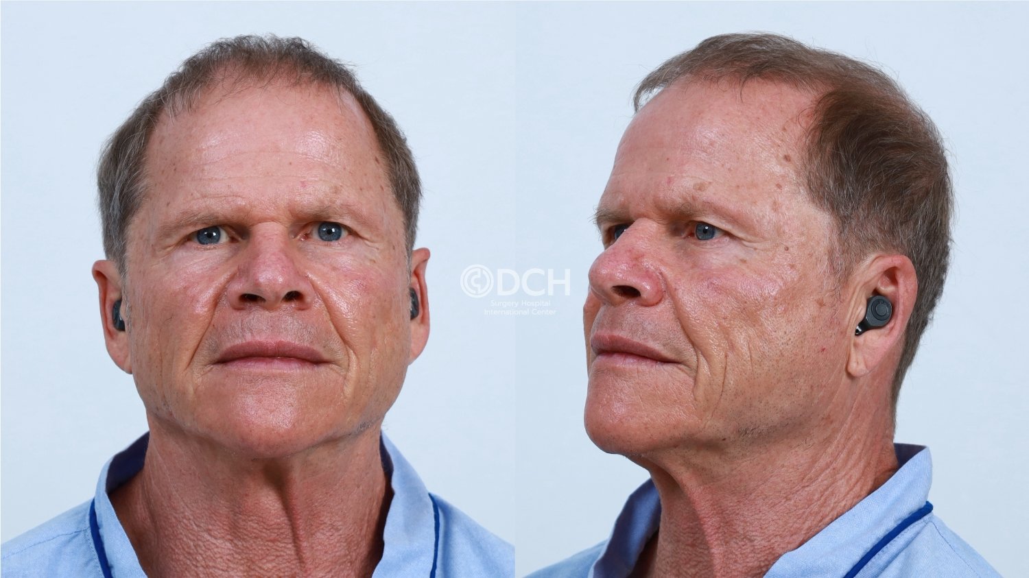 Facial and neck laxity before full facelift and neck lift treatment in Thailand