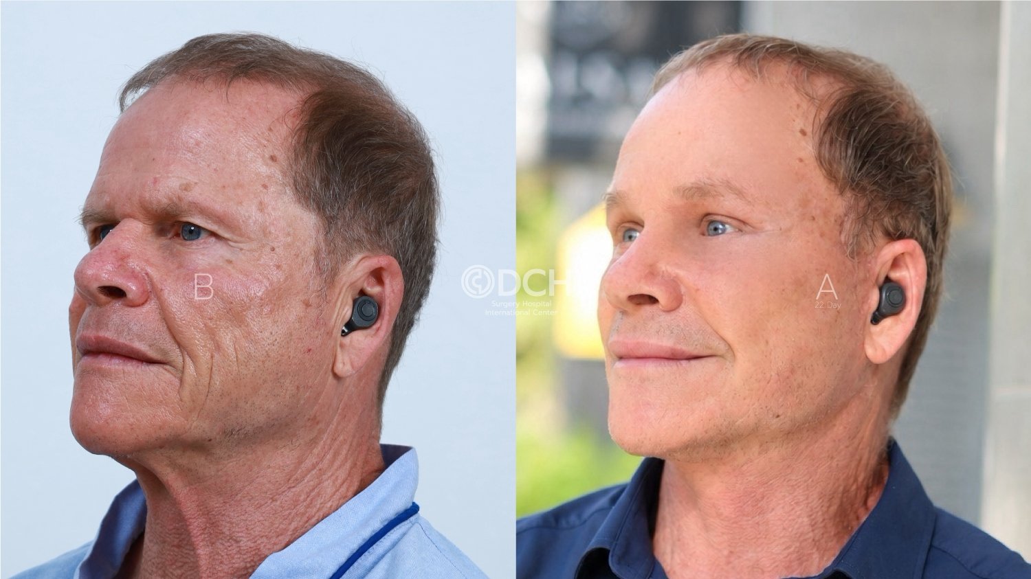Male neck lift and facelift in Thailand before and 22 days after treatment