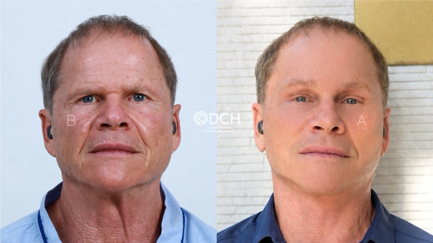 67-year-old male facelift and neck lift in Thailand before and 22 days after surgery