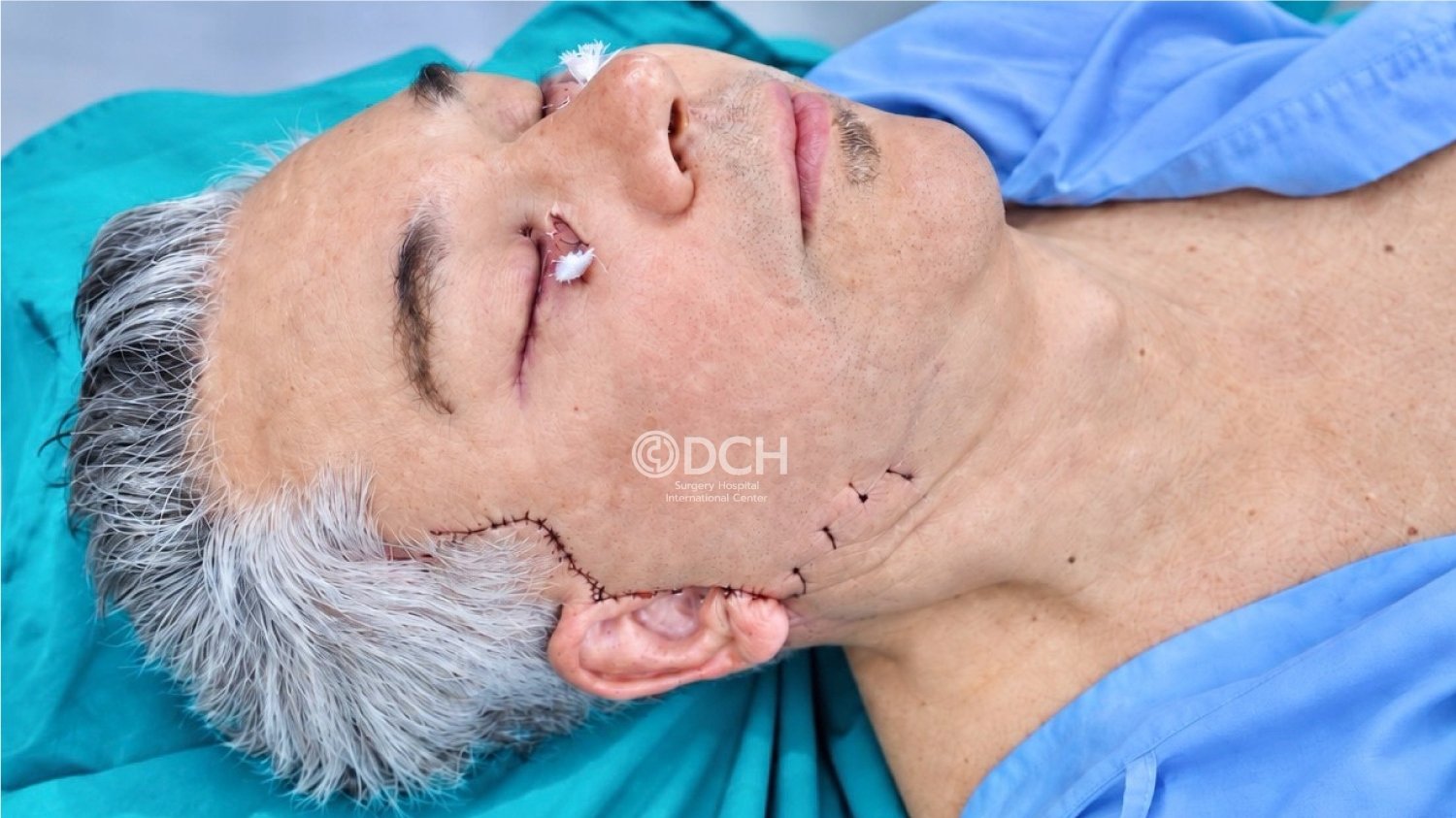 Immediate postoperative stage after male facelift and lower blepharoplasty in Thailand