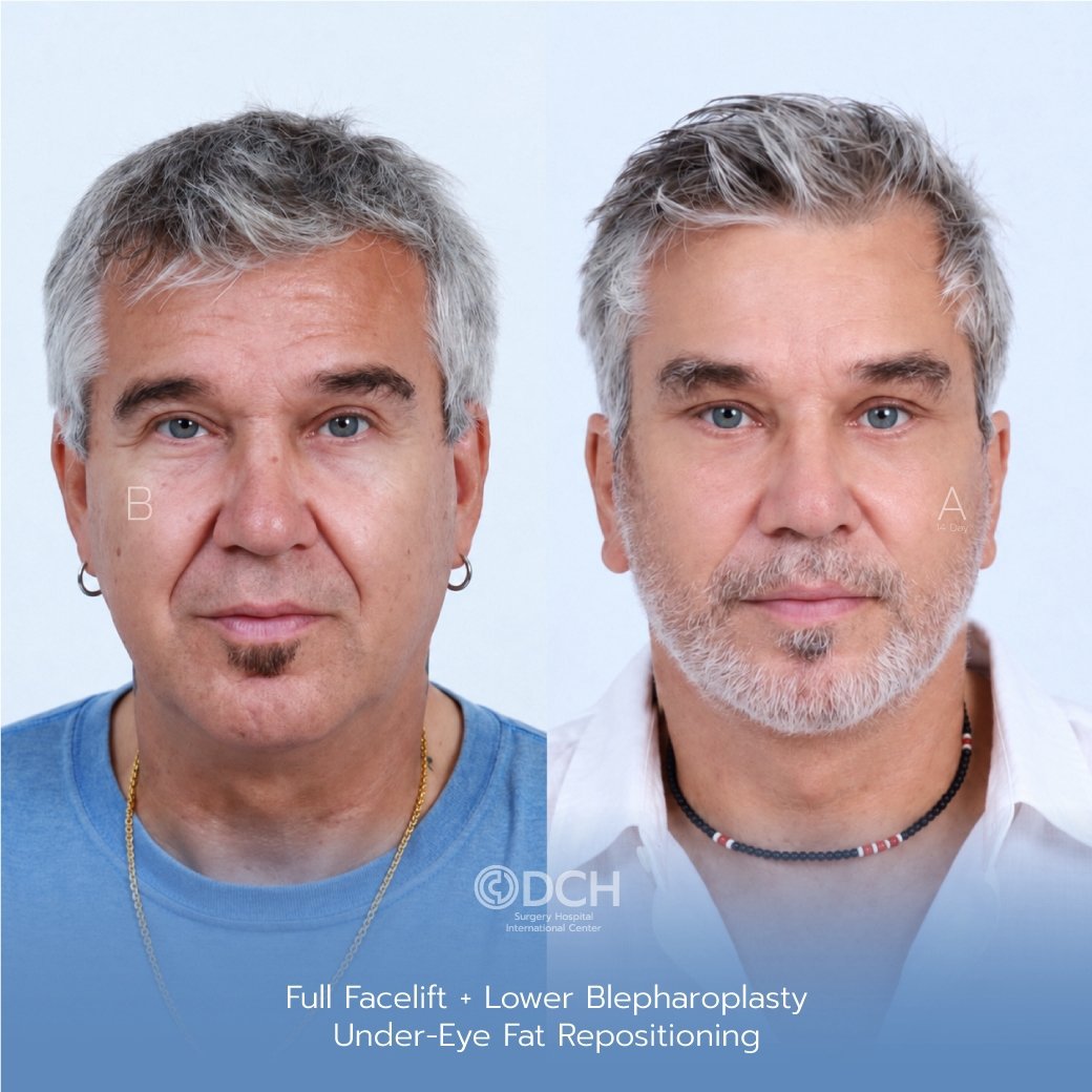 Male facelift in Thailand before and 14 days after surgery