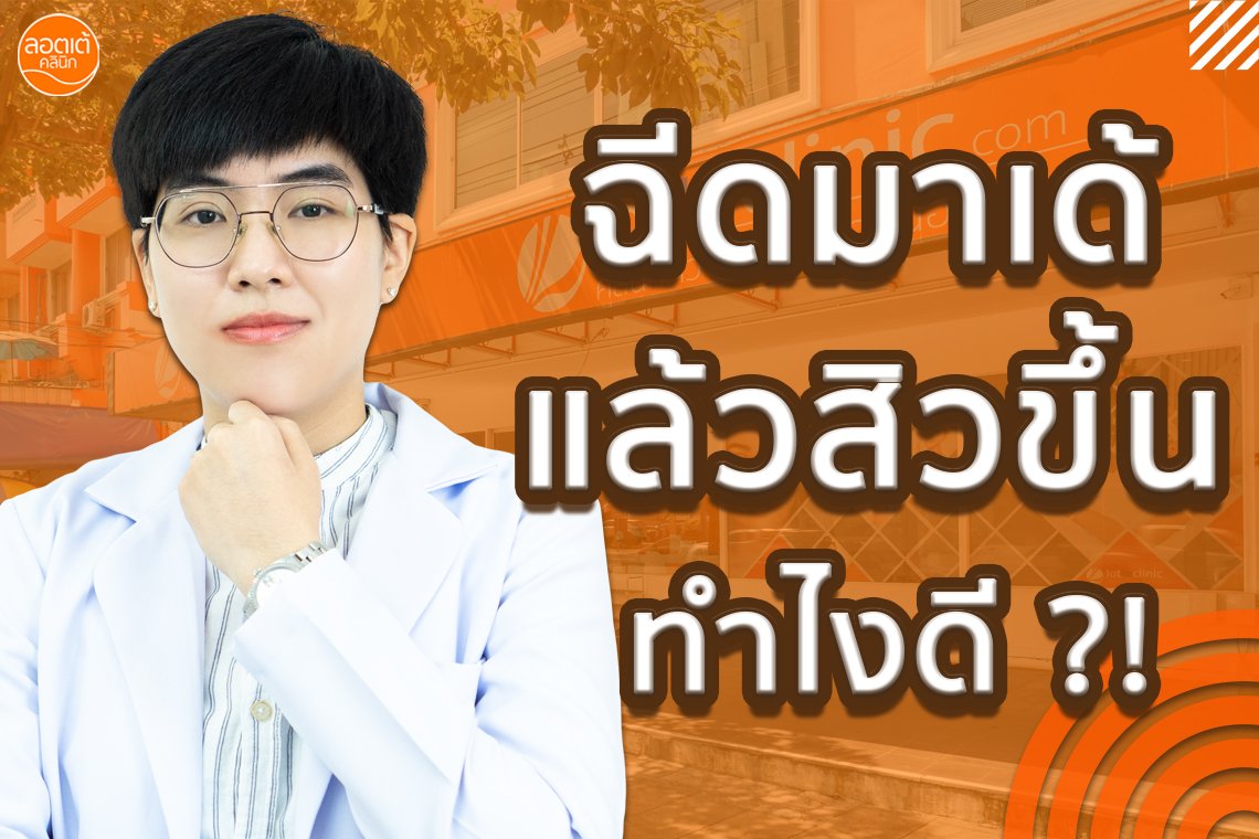 ฉีดมาเด้แล้วสิวขึ้น ทำไงดี ?!
