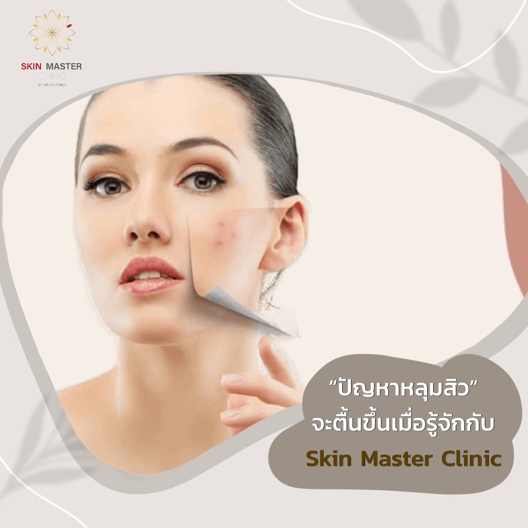 ปัญหาหลุมสิว” จะตื้นขึ้น เมื่อรู้จักกับ Skin Master Clinic