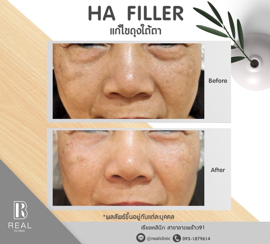 ฟิลเลอร์ใต้ตา ฉีดฟิลเลอร์ใต้ตา ฟิลเลอร์ใต้ตาที่ไหนดี ฟิลเลอร์ใต้ตา ฉีดฟิลเลอร์ใต้ตา ฟิลเลอร์ใต้ตาที่ไหนดี