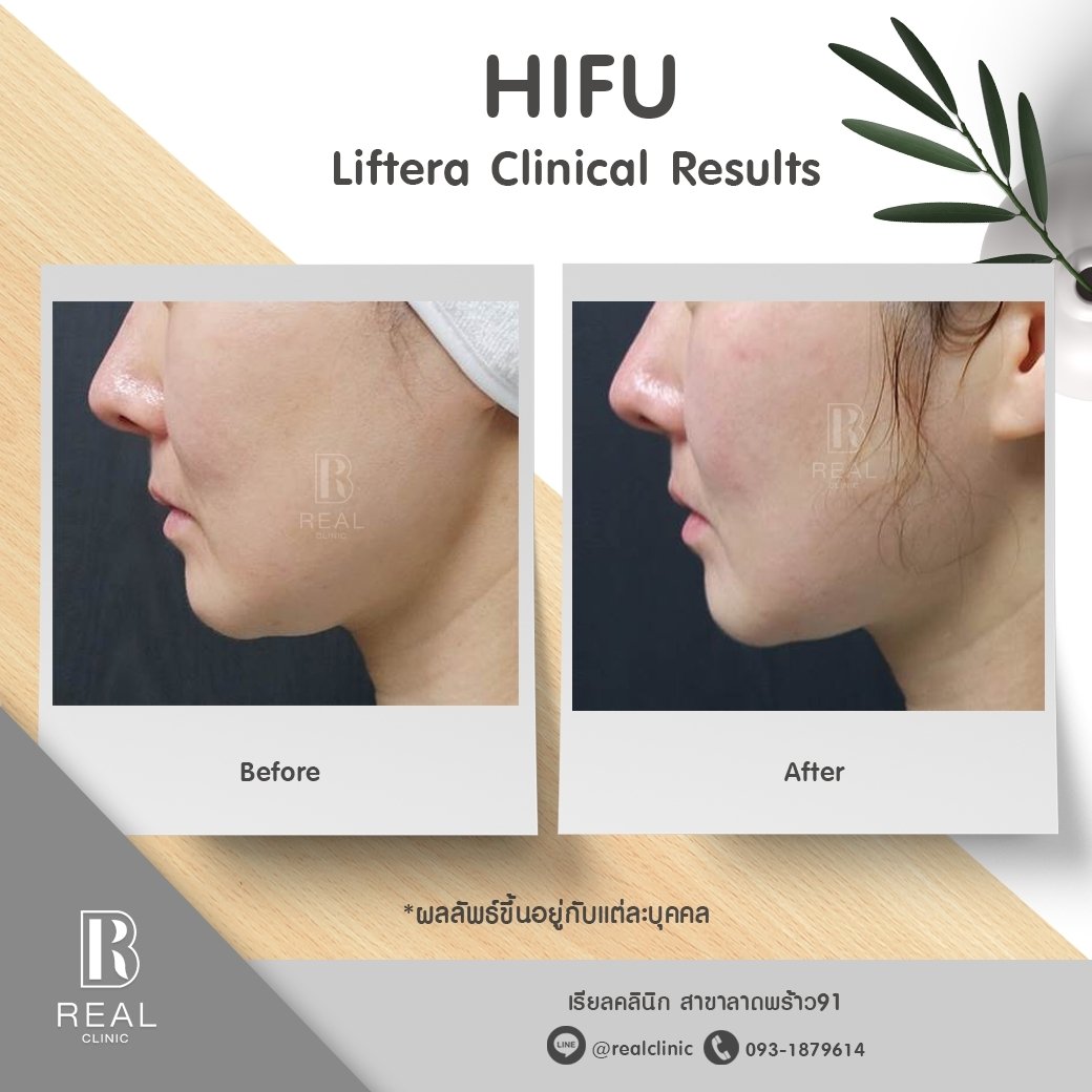 hifu รีวิว real clinic