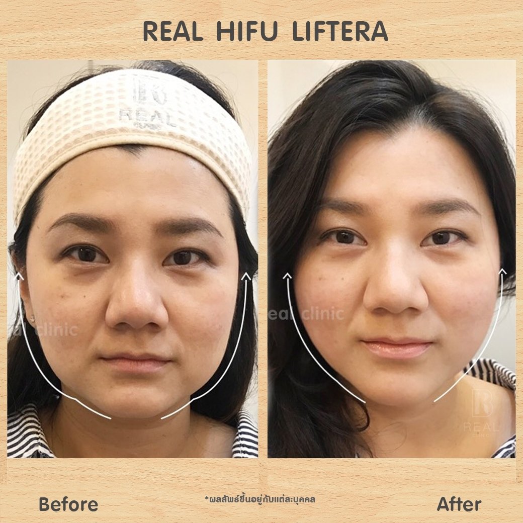 hifu รีวิว real clinic