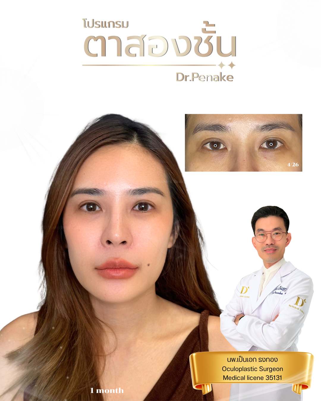 double eyelid surgery 