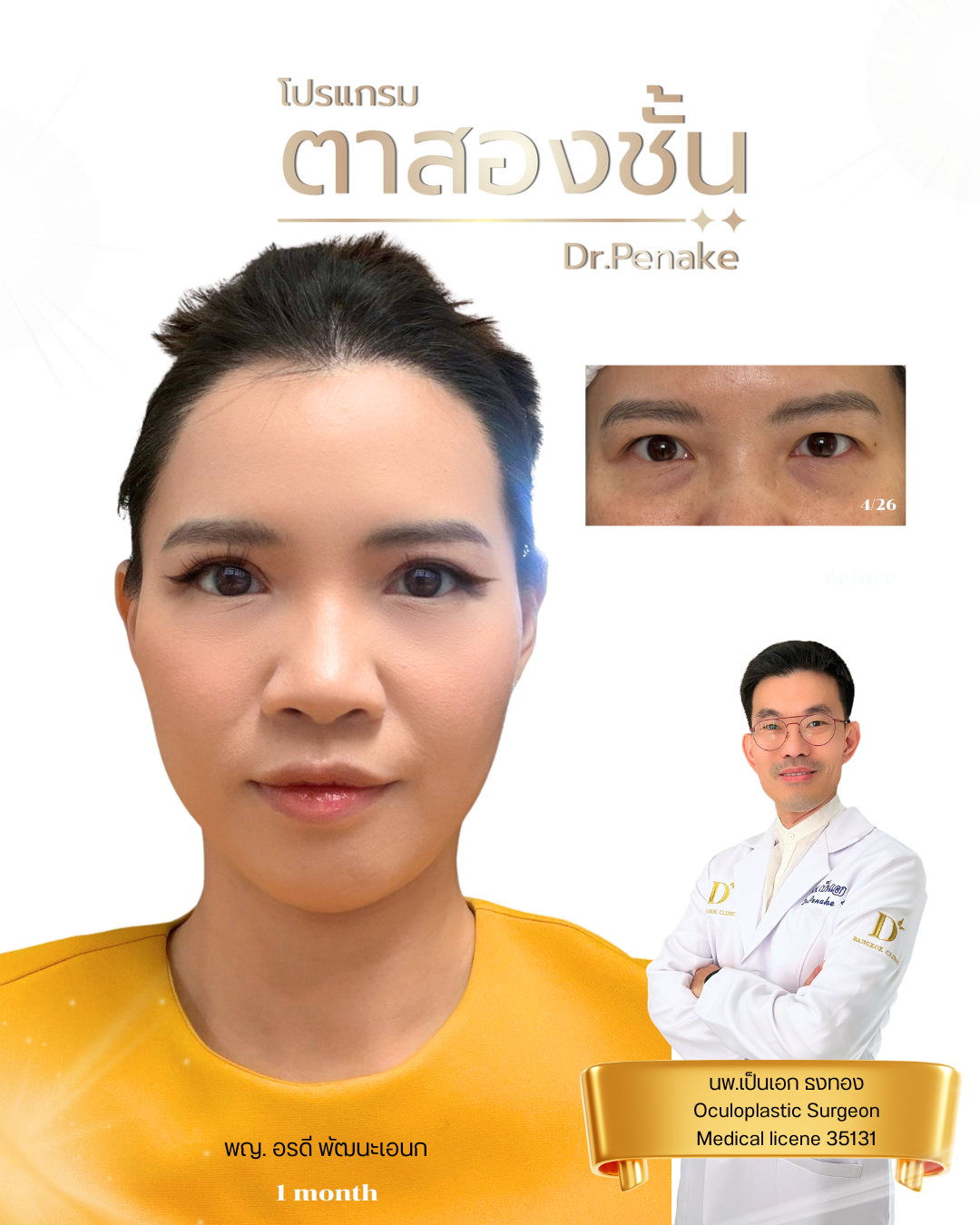 ตาสองชั้นธรรมชาติ 