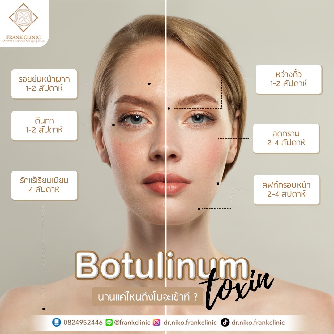 โบกี่วันเริ่มเห็นผล??  ใครบ้างที่ควรฉีด Botox??