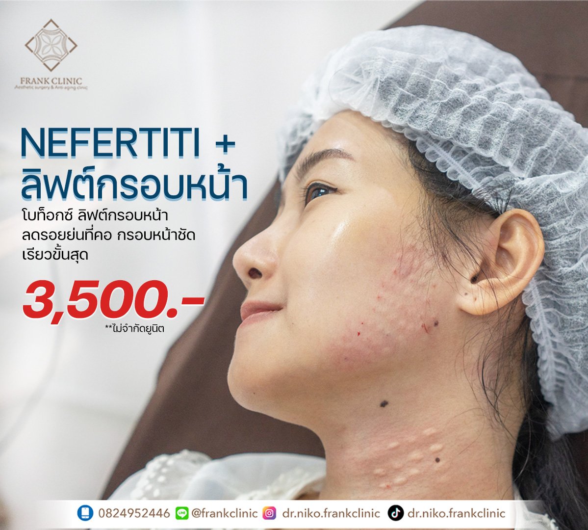 ฉีดโบลิฟต์กรอบหน้า คืออะไร? NEFERTITI LIFT คืออะไร?